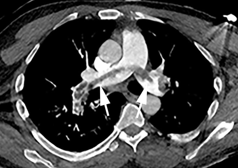 A saddle embolus in a CT scan of a 52-year-old male patient presenting in the emergency department with hypoxia and tachycardia. Image courtesy of Margarita Revzin et al. 