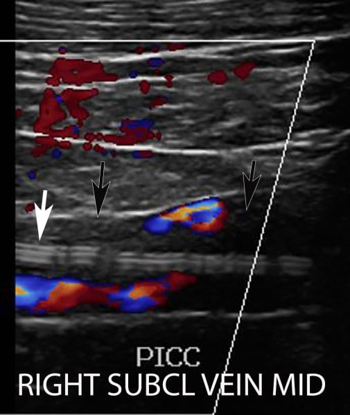 Deep vein thrombosis (DVT) associated with a peripherally inserted central catheter (PICC) line in a 54-year-old man with COVID-19. Sagittal color Doppler ultrasound image shows an echogenic thrombus (black arrows) in the right subclavian vein, associated with the PICC line (white arrow). Image courtesy of Margarita Revzin et al.  Clot caused by COVID