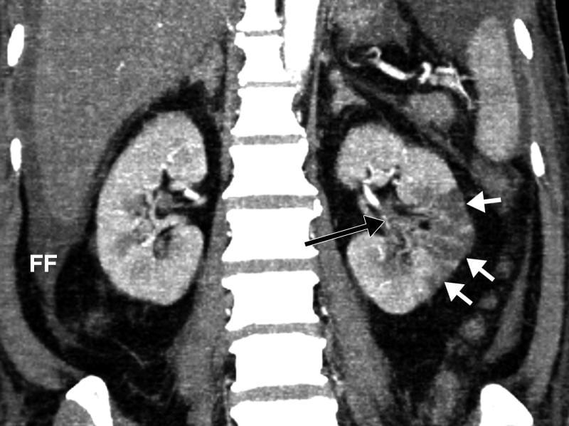 Example of kidney infarct organ damage caused by COVID-caused clotting in a 57-year-old man with COVID-19 who presented with abdominal pain. Image courtesy of Margarita Rezvin et al.  Read more on the trials examining the use of anticoagulation to treat COVID clotting.