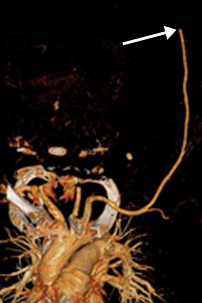 Brachial artery thrombosis in a 51-year-old man who presented to the emergency department with acute left upper extremity pain and numbness. The patient had a 2-week history of cough and fever and was confirmed to be COVID-19 positive. (a) Coronal left upper extremity CT angiographic image shows an abrupt segmental occlusion (arrow) of the distal left brachial artery, indicative of peripheral arterial thromboembolization. Coronal three-dimensional maximum intensity projection shows abrupt cutoff (arrow) of 