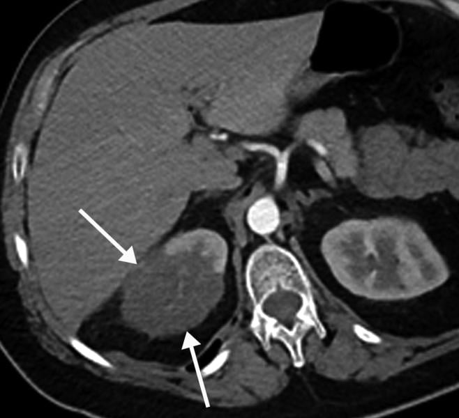 Renal infarct in a 51-year-old man. The patient had a 2-week history of cough and fever and was confirmed to be COVID-19 positive. Axial chest CT angiographic images show the typical appearance of lung changes in COVID-19 pneumonia. Further review of the dataset showed a sharp well-defined area of nonenhancement in the partially imaged upper pole of the right kidney, a finding indicative of a renal infarct (arrows). COVID causes clot formation throughout the body in some patients, leading to organ infarcts.