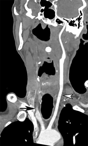 Common carotid artery (CCA) occlusion in a 56-year-old woman with neurologic deficits who had been hospitalized with COVID-19. Coronal three-dimensional maximum intensity projection reformatted image of the head and neck show an abrupt cutoff at the origin of the CCA (black arrow). The left carotid vasculature is well opacified with intravenous contrast material (white arrow). Image courtesy of Margarita Revzin et al. COVID caused clot and stroke