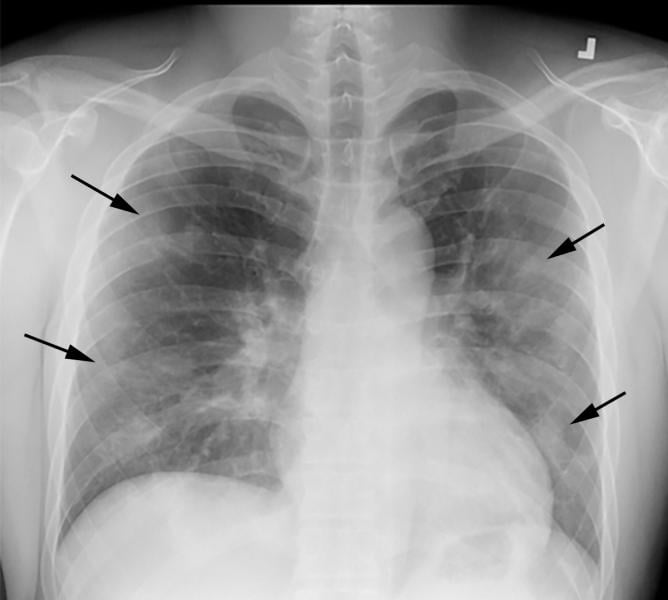 COVID-19 progression over 4 days in a 28-year-old man. This posteroranterior chest X-ray \ shows bilateral multiple peripheral and lower lobe ground glass opacities (GGOs) shown by the arrows. Image courtesy of Margarita Revzin et al.  COVID X-ray image.