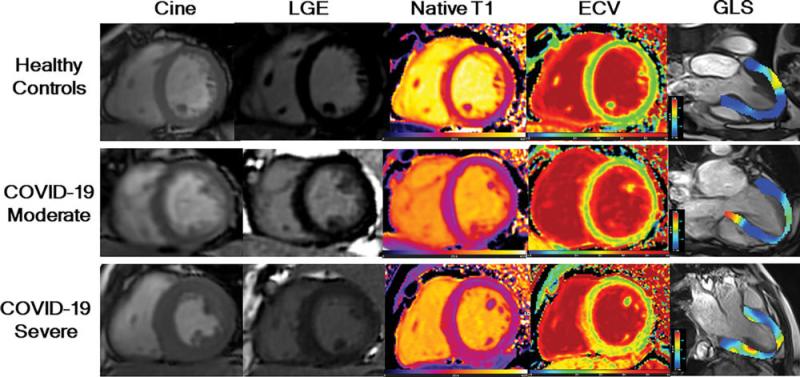 Figure 2. LGE images, native T1 maps, extracellular volume maps, and global longitudinal strain (GLS) show myocardial abnormalities in adults recovering from moderate and severe COVID-19. Note: this image is for illustrative purposes only and is not associated with the Big Ten study group. Image courtesy of Radiology.