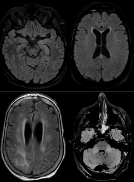Figure 2. Axial FLAIR in four different COVID-19 patients. A) 58-year old man with impaired consciousness: FLAIR hyperintensities located in the left medial temporal lobe. B) 66-year old man with impaired consciousness: FLAIR ovoid hyperintense lesion located in the central part of the splenium of the corpus callosum. C) 71-year old woman with pathological wakefulness after sedation: extensive and confluent supratentorial white matter FLAIR hyperintensities. Association with leptomeningeal enhancement. D) 6