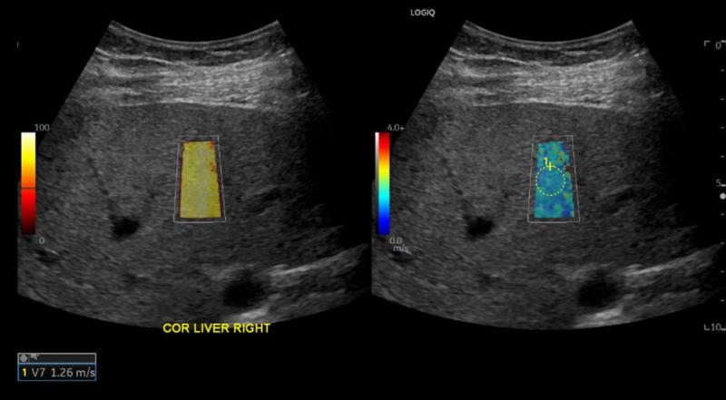 Figure 2. A 57-year-old female without a history of positive COVID-19 test before the date of ultrasound shear wave elastography. The shear wave speed of 1.26 m/s corresponds to Young’s modulus of 4.76 kPa which indicates normal liver stiffness.