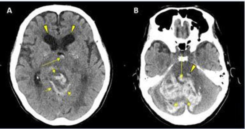 Figure 3. CT showing hemorrhage in a 68-year-old male patient with COVID-19 infection.