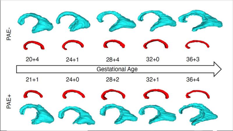 Figure 3. Longitudinal growth trajectories of the periventricular zone (blue) and the corpus callosum (red) in fetuses with (PAE+) and without (PAE-) prenatal alcohol exposure. The volumetric relations of included images are not representative: The scaling has been altered to allow for an easy comparison of shape and structure of the respective compartments.