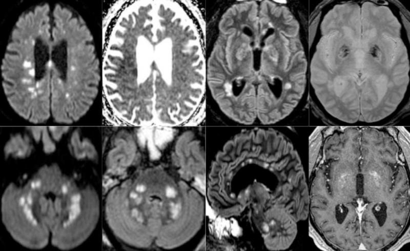 Figure 3. 65-year old man with pathological wakefulness after sedation. Non-confluent multifocal white matter hyperintense lesions on FLAIR and diffusion, with variable enhancement, and hemorrhagic lesions. Axial Diffusion (A, B), Apparent Diffusion Coefficient (ADC) map (C), axial FLAIR (D, E), sagittal FLAIR (F), axial Susceptibility weighted imaging (SWI) (G), and postcontrast T1 weighted MR images (H). Multiple nodular hyperintense Diffusion and FLAIR lesions localized in the white matter including the 