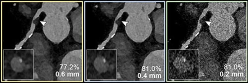 Coronary CT angiography for the suspected progression of known coronary artery disease in a 60-year-old female patient. 