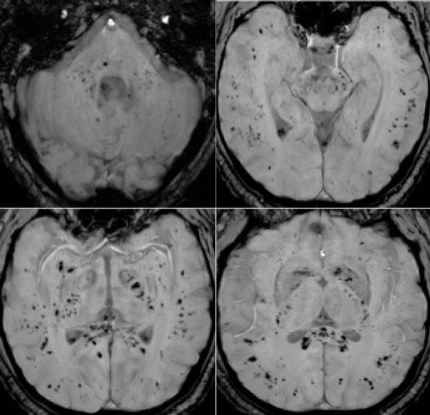 Figure 4. 57-year old man with pathological wakefulness after sedation. Extensive and isolated white matter microhemorrhages. Axial Susceptibility weighted imaging (SWI) (A, B, C, D): multiple microhemorrhages mainly affecting the subcortical white matter, corpus callosum, internal capsule, and cerebellar peduncles.