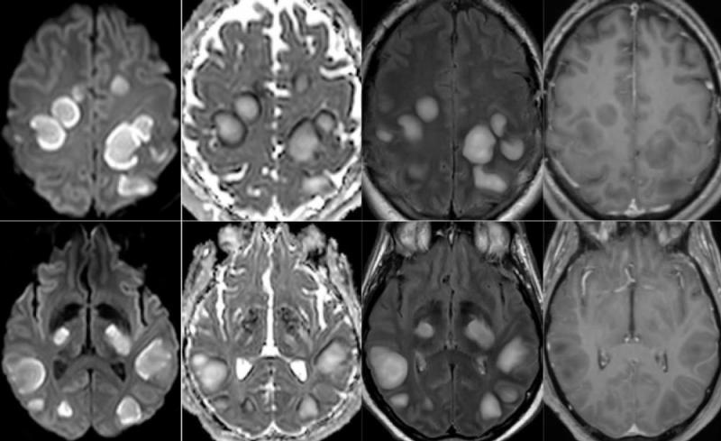 Figure 5. 54-year old man with pathological wakefulness after sedation. Non-confluent multifocal white matter hyperintense lesions on FLAIR and diffusion, with variable enhancement. Axial Diffusion (A, B), Apparent Diffusion Coefficient (ADC) map (C, D), axial postcontrast FLAIR (E, F), and postcontrast T1 weighted MR images (G, H). Multiple nodular hyperintense Diffusion and FLAIR subcortical and corticospinal tracts lesions, with very mild mass effect on adjacent structures. The lesions present a center w
