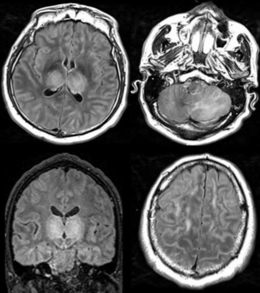Figure 6. 51-year old man with impaired consciousness. Acute necrotizing encephalopathy. Axial FLAIR (A, C, D), and coronal FLAIR (B): bilateral FLAIR hyperintensity in both thalami (A, B), associated with involvement of the cerebellar (C), and cerebral (D) white matter. FLAIR = Fluid-attenuated inversion recovery