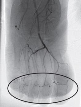 DSA image of right foot obtained approximately 24 hours after infusion of 1 mg/h intraarterial tPA, concomitant systemic IV heparin (500 U/h), and daily 81 mg aspirin shows marked interval pedal digital revascularization, with reappearance of digital arteries (oval