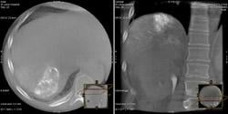 Repeat 3-D CT spin confirms success of embolization