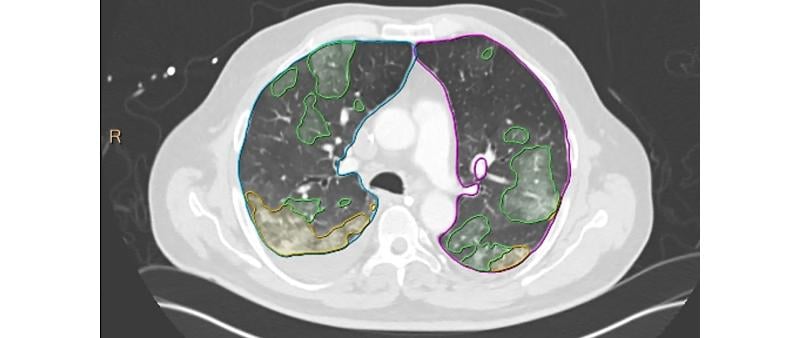 Artificial intelligence algorithm automatically identifies areas of COVID-19 pneumonia on a lung and quanfities the lesions without huamn intervention to help speed workflow. Several vendors developed COVID-19 specific AI algorithms in 2020, including Siemens and Philips. This is Philips' CT Pulmo Auto Results CT. The software performs automatic lung segmentation and lesion segmentation, together with classification of ground glass opacities/consolidation. Its automatically generated reports include volume.