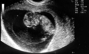 Abortion and the Politics of Forced Ultrasound