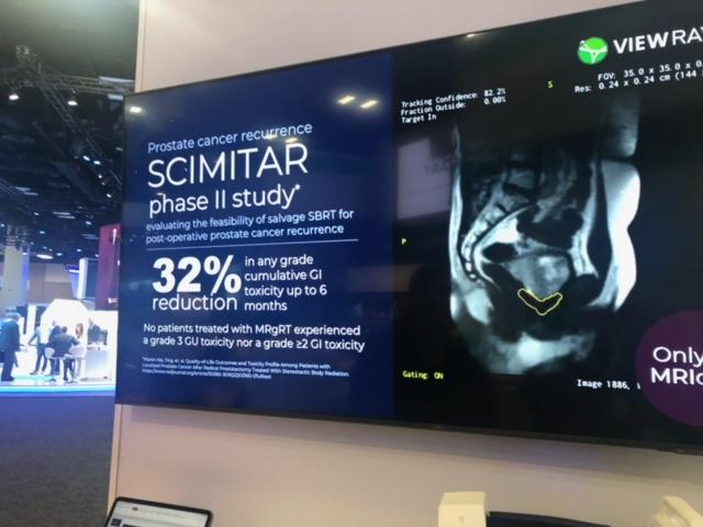 At ASTRO, ViewRay discussed the first toxicity results from the prospective single-arm Phase II SCIMITAR trial. A secondary analysis compared the findings of treatment under CT-guidance to MRI-guidance and found that patients treated with MRI-guidance had a 30.5 percent reduction in any grade acute GI toxicity and a 32 percent reduction in any grade cumulative GI toxicity up to 6 months. No patient treated with MRI-guided radiation therapy experienced any grade 3 GU or GI toxicity. 