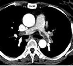  Study Shows SPECT/CT Effective in Detecting Pulmonary Embolism