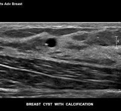 Philips Epiq ultrasound image of a breast cyst and calcifications. Breast ultrasound is often used as an augmentation of mammography in women with dense breast tissue. 