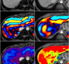 2008-05-06-brice-elastograp