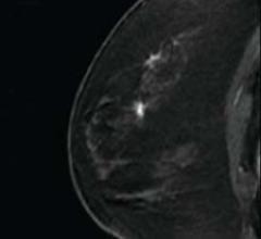 MRI-guided breast biopsy with the Suros ATEC system is viewed as one of the patient follow-up protoc