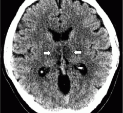 #COVID19 #Coronavirus #2019nCoV #Wuhanvirus #SARScov2 A brief article from Henry Ford Health System in Detroit, published today in Radiology, reports on the first presumptive case of COVID-19–associated acute necrotizing hemorrhagic encephalopathy.
