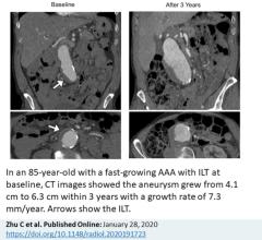 The researchers used high resolution cross-sectional imaging with CT or MRI to assess 225 men with abdominal aortic aneurysm. Follow-up lasted, on average, more than three years.  Slightly more than half of patients had an intraluminal thrombus. The aneurysms of those with intraluminal thrombus were larger at baseline and grew by a rate of 2 mm per year, twice as fast as the 1 mm per year growth rate in people without intraluminal thrombus.