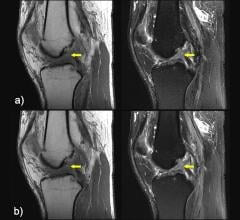 Image reconstruction in a 52-year-old man referred for clinical knee MRI with an anterior cruciate ligament tear. The ligament tear, indicated by the yellow arrows, can be seen equally well in (A) the conventional protocol images and (B) the deep learning protocol images. 