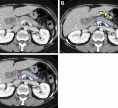 Analysis of nontumorous portion of pancreas with or without secondary signs of pancreatic cancer by classification models. Blue outline represents the portion of the pancreas analyzed with classification models. The tumor (red outline) was not identified by the segmentation model; thus, it was not analyzed by classification models. (A) Unannotated CT image in a patient with pancreatic head cancer. (B) Nontumorous portion of the pancreas shows secondary signs of pancreatic cancer (dilation of pancreatic duct