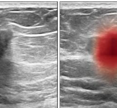September 28, 2021 — A computer program trained to see patterns among thousands of breast ultrasound images can aid physicians in accurately diagnosing breast cancer, a new study shows.
