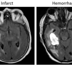 Examples of axial FLAIR sequences from studies within dataset A. From left to right: a patient with a 'likely normal' brain; a patient presenting an intraparenchymal hemorrhage within the right temporal lobe; a patient presenting an acute infarct of the inferior division of the right middle cerebral artery; and a patient with known neurocysticercosis presenting a rounded cystic lesion in the left middle frontal gyrus. Image courtesy of Radiological Society of North America