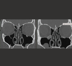 Report: Advances in CT Continue to Drive Radiation Dose Reduction