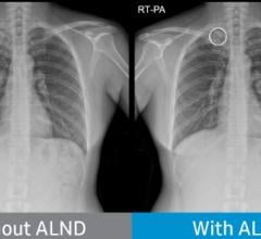Chest radiograph without Auto Lung Nodule Detection (ALND) and chest radiograph with lung nodule marked.