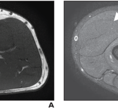 Axial T1-weighted (A) and STIR (B) images depict denervation edemalike signal of extensor muscles of dorsal and mobile wad compartments with no fatty infiltration or atrophy consistent with NS-RADS M1.
