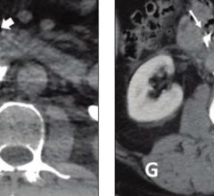 58-year-old patient referred for complex IVC filter retrieval after dwell time of 72 months. 