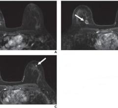 A, Contrast-enhanced axial T1-weighted fat-saturated image from baseline MRI before initiation of neoadjuvant therapy shows irregular mass (arrow) in upper inner right breast corresponding to biopsy-proven carcinoma. B, Contrast-enhanced axial T1-weighted fat-saturated image from follow-up MRI performed 3 months after initiation of neoadjuvant therapy shows decrease in size of right breast cancer (arrow). C, Contrast-enhanced axial T1-weighted fat-saturated image 3 months after initiation of neoadjuvant the
