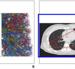 B, Representative computational model shows lung stroma intraorgan structure of XCAT phantom that was developed using anatomically informed mathematic model. Inset shows enlarged view for better visibility of details and small structures. C, Voxelized rendition (ground truth) of XCAT phantom highlights detailed model of lung parenchyma. Inset shows enlarged view for better visibility of details and small structures