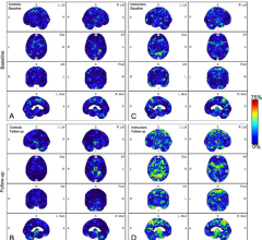 Parametric maps of amyloid deposition in healthy control participants (A and B) and blast-exposed military instructors (C and D) at baseline (A and C) and follow-up (B and D). The blue-to-red scale indicates the frequency of statistically abnormal amyloid uptake in a particular brain voxel. Whereas no abnormal amyloid uptake was identified at baseline or follow-up in healthy control participants (A, B), amyloid deposition occurred most frequently in blast-exposed participants in the superior parietal lobule