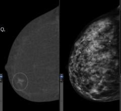Study aims to determine whether CEM improves breast cancer detection for women with dense breasts 