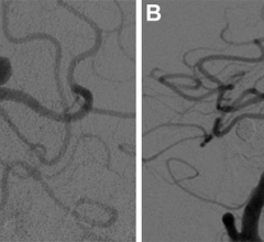 Digital subtraction angiography images show basilar tip aneurysm (A) before and (B) at last follow-up after Woven EndoBridge device placement. Image courtesy of Radiological Society of North America