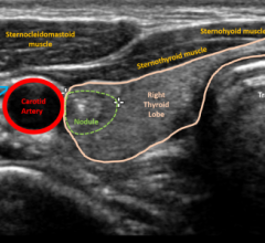 Using artificial intelligence to predice risk of thyroid cancer on ultrasound.