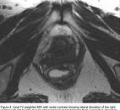 Axial T2 Weighted MRI