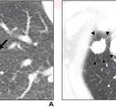 (A) 70-year-old woman with pulmonary adenocarcinoma who underwent sublobar resection without evidence for pLVI. 15-mm solid nodule with irregular margins present in right lower lobe (arrow). No tumor recurrence on 37-month follow-up. (B) 75-year-old man with pulmonary adenocarcinoma who underwent wedge resection that exhibited pLVI. 19-mm solid nodule with irregular margins and peritumoral interstitial thickening (arrowheads) present in right upper lobe. Ipsilateral mediastinal and hilar lymph node metastas