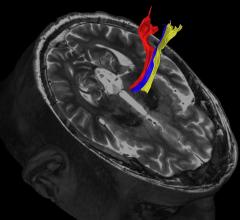 Diffusion tractography uses the movement of water molecules to identify tracts that connect different parts of the brain. It can be used to pinpoint the part of the thalamus to treat with focused ultrasound. Image courtesy of UT Southwestern Medical Center