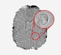 Smoldering Spots in the Brain May Signal Severe MS