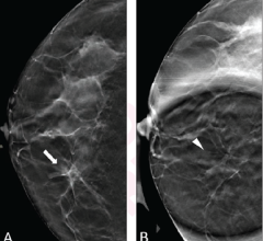 52-Year-Old Woman Presenting for Asymmetry of Right Breast: (A) DBT craniocaudal view shows asymmetry (arrow) in medial right breast (DBT). (B) DBT spot compression view shows asymmetry does not persist (arrowhead). Lesion classified on DBT without, and DBT with, DBT spot compression view as BI-RADS category 4a and 2 by reader 1, category 4a and 2 by reader 2, and category 4b and 2 by reader 3. Follow-up imaging at one year demonstrated stability of finding, consistent with benignity in present analysis.