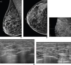According to ARRS’ American Journal of Roentgenology (AJR), return to routine screening for BI-RADS 3 lesions on supplemental automated whole-breast US (ABUS) substantially reduces the recall rate, while being unlikely to result in adverse outcome