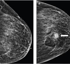 85-year-old patient who maintained daily use of 81 mg of aspirin at time of stereotactic-guided core-needle biopsy of group of breast calcifications; pathologic assessment yielded atypical ductal hyperplasia.