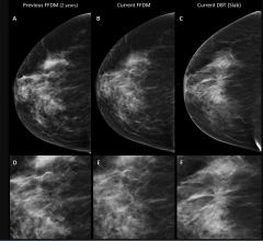 Breast Tomosynthesis Increases Cancer Detection Over Digital Mammography